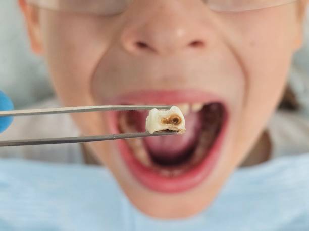 Best Broken or Cracked Tooth Emergency Dentist in Santa Venetia, CA
